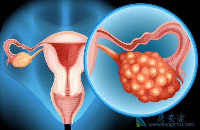 卵巢癌分期 卵巢癌分期