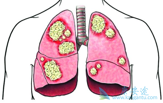 晚期肺癌治疗 晚期肺癌治疗