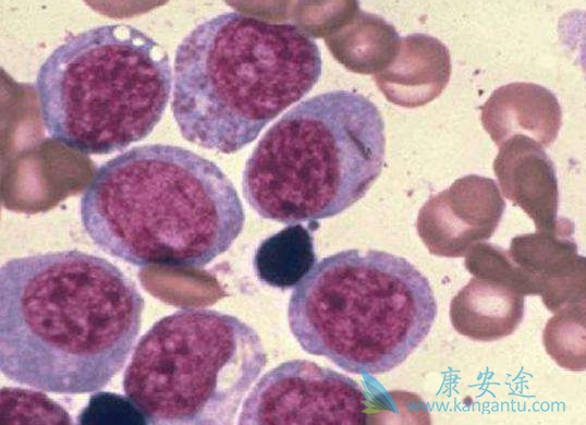 霍奇金淋巴瘤 霍奇金淋巴瘤