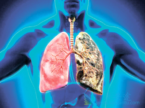 晚期肺癌治疗 晚期肺癌治疗