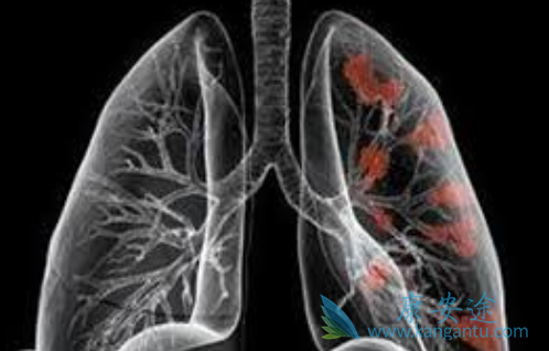 肺癌EGFR药物 肺癌EGFR药物