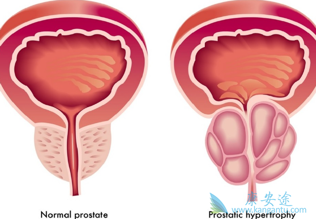 前列腺癌治疗 前列腺癌治疗