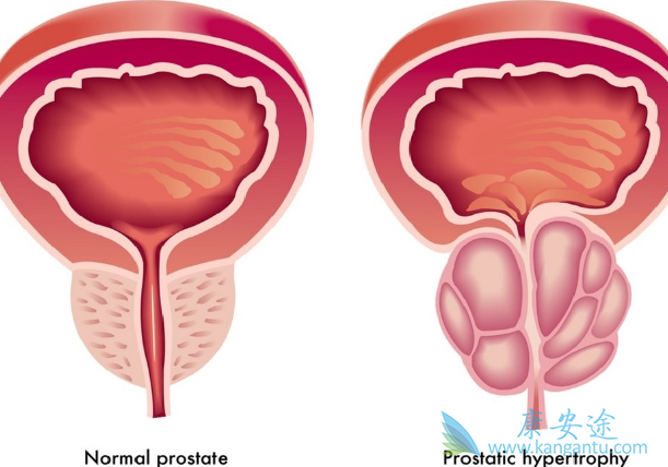 前列腺癌治疗 前列腺癌治疗