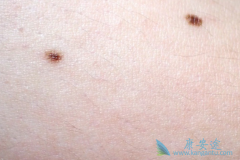 ��ɫ�������Ʒ���������֢״