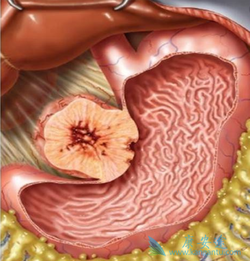 胃肠道间质瘤 胃肠道间质瘤