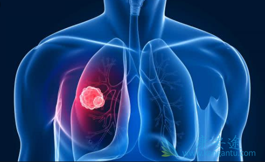 肺癌 肺癌
