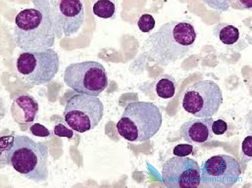 多发性骨髓瘤 多发性骨髓瘤