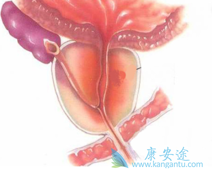 前列腺癌 前列腺癌