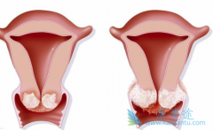 �����ӹ�����ԭ����ʲô����ʲô֢״��