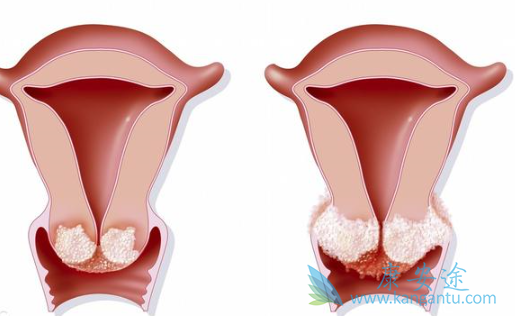 子宫癌的原因 子宫癌的原因