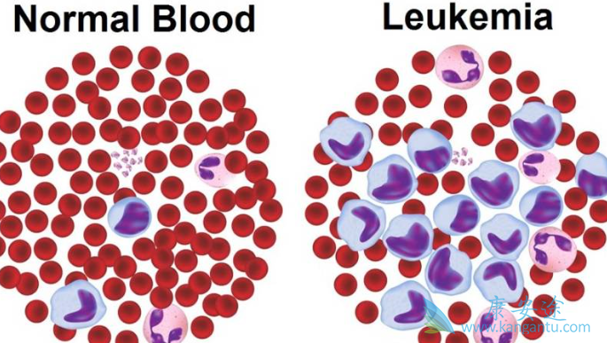 白血病的治疗 白血病的治疗