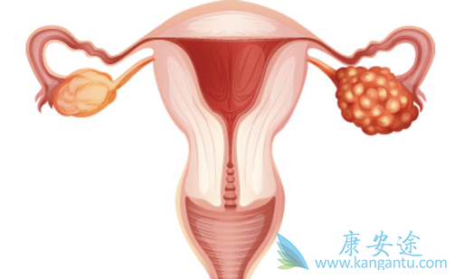 卵巢癌的早期症状 卵巢癌的早期症状