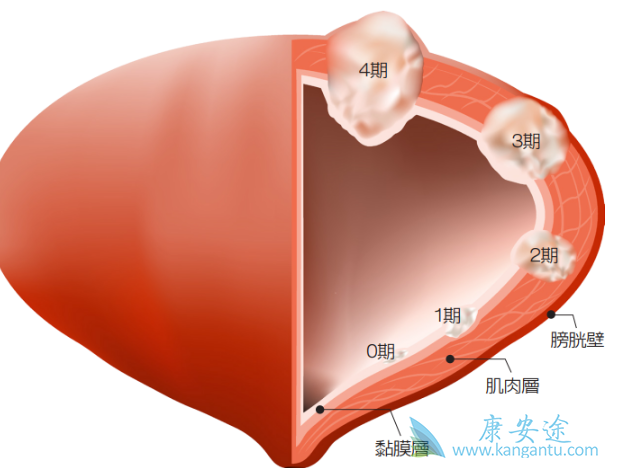 膀胱癌的早期症状 膀胱癌的早期症状