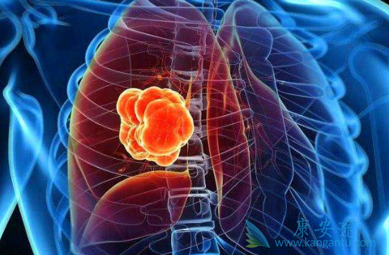 肺癌晚期有治好的吗 肺癌晚期有治好的吗