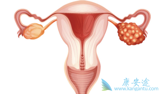 卵巢癌晚期能活多久 卵巢癌晚期能活多久