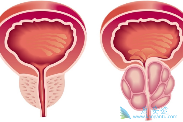 前列腺癌症 前列腺癌症