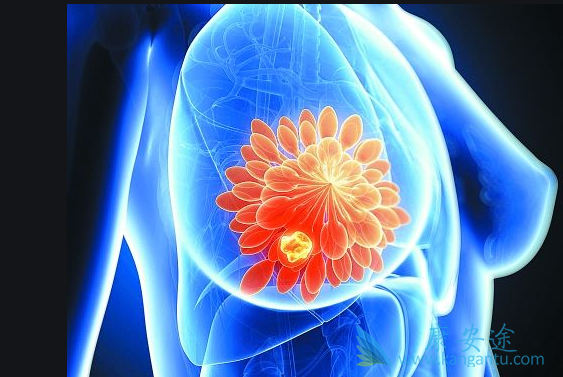 乳腺癌晚期能活多久;乳腺癌原因 乳腺癌晚期能活多久;乳腺癌原因