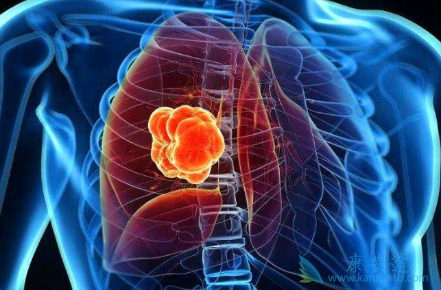 肺癌晚期死前症状 肺癌晚期死前症状