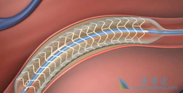 心脏支架手术后寿命;心脏支架手术费用 心脏支架手术后寿命;心脏支架手术费用