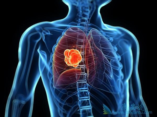 肺癌 肺癌