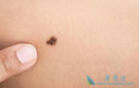 黑色素瘤治疗方法 黑色素瘤治疗方法