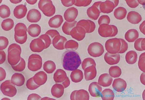 慢性淋巴细胞白血病 慢性淋巴细胞白血病