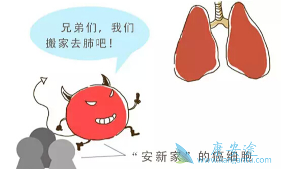 癌症转移;肺癌肝转移 癌症转移;肺癌肝转移