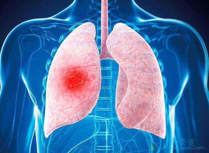 肺癌晚期可以治好吗;肺癌治疗 肺癌晚期可以治好吗;肺癌治疗