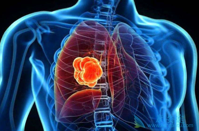 肺癌晚期怎么治疗 肺癌晚期怎么治疗