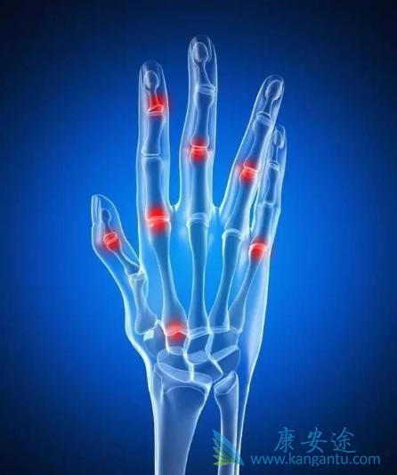 风湿关节炎 风湿关节炎