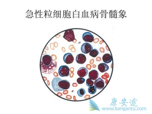 急性髓白血病 急性髓白血病