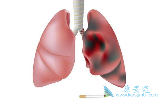 肺癌晚期特效药;肺癌治疗 肺癌晚期特效药;肺癌治疗