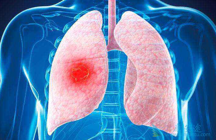 小细胞肺癌;非小细胞肺癌 小细胞肺癌;非小细胞肺癌