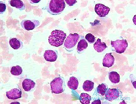 急性髓细胞性白血病 急性髓细胞性白血病