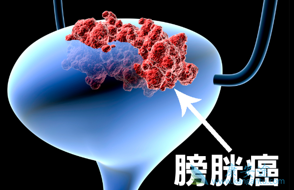 膀胱癌的早期症状 膀胱癌的早期症状