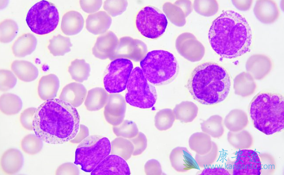 慢粒白血病 慢粒白血病