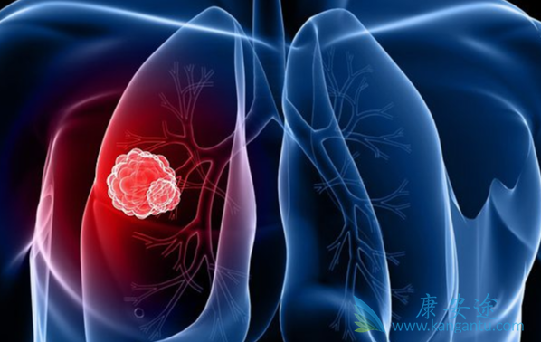晚期非小细胞肺癌 晚期非小细胞肺癌