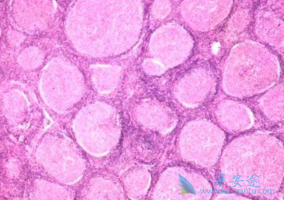 霍奇金淋巴瘤 霍奇金淋巴瘤