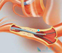 ���˰������ƻ�����Щ�������ư�֢��ʲô���׻�����������