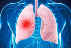 �ΰ�EGFRҩ��Էΰ������в�����Ч��