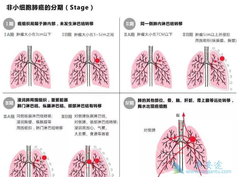 非小细胞肺癌 非小细胞肺癌