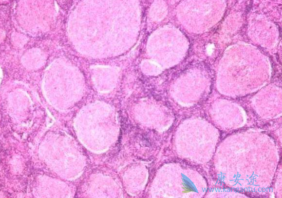 霍奇金淋巴瘤 霍奇金淋巴瘤