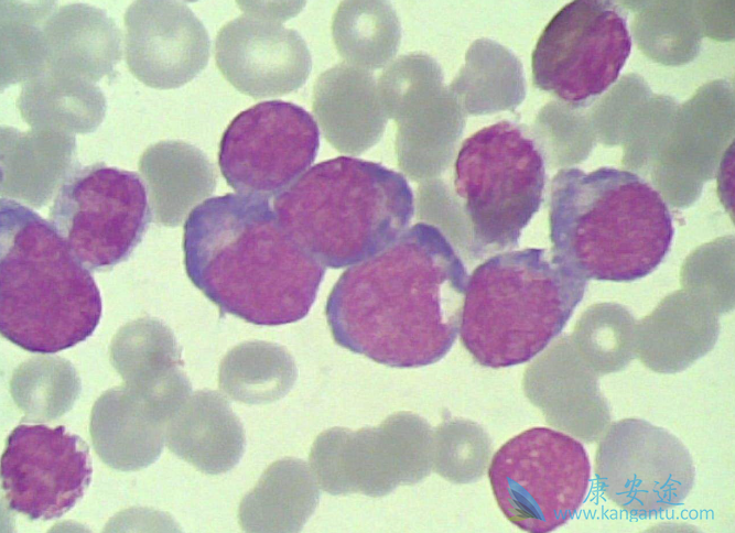 急性髓细胞白血病 急性髓细胞白血病