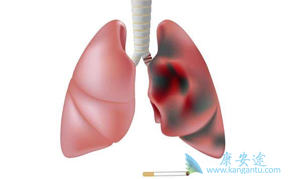 肺癌晚期;肺癌的治疗 肺癌晚期;肺癌的治疗