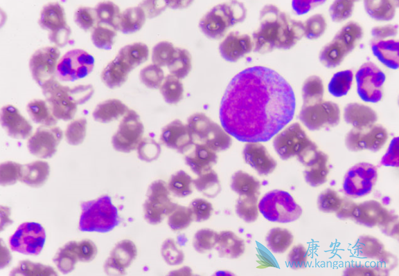 急性髓细胞白血病 急性髓细胞白血病