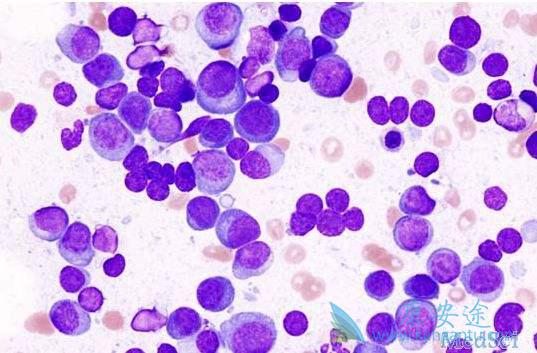 多发性骨髓瘤 多发性骨髓瘤