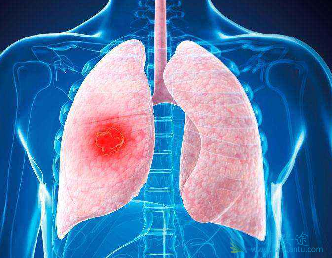 肺癌 肺癌
