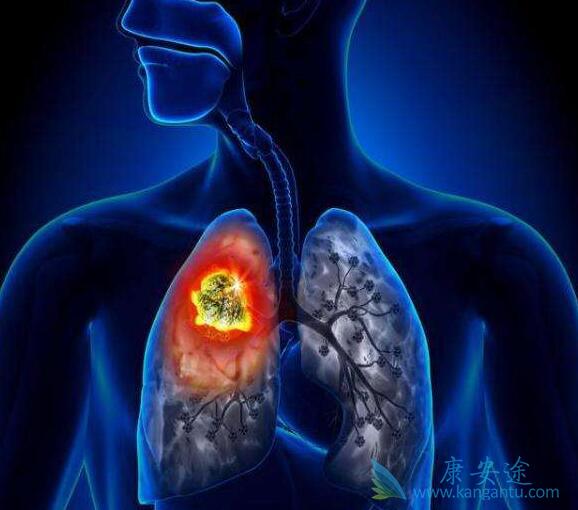 肺癌患者一定要积极接受治疗 肺癌患者一定要积极接受治疗