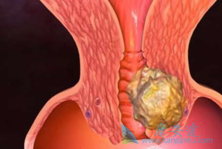 卵巢癌的早期症状;卵巢癌 卵巢癌的早期症状;卵巢癌