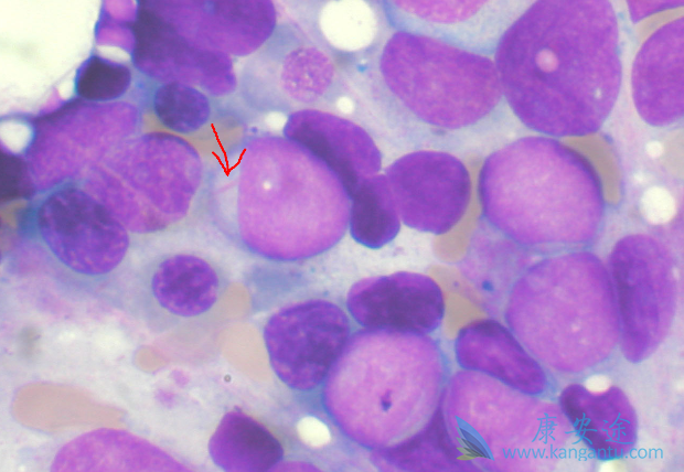 急性髓细胞白血病 急性髓细胞白血病